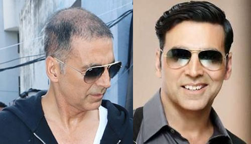10 Bollywood Celebrities Who Got A Career Boost After Getting A Hair  Transplant/Patch - DotComStories
