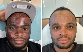 tiktok chemical peel burned victim neyo white 2023,tiktok chemical peel