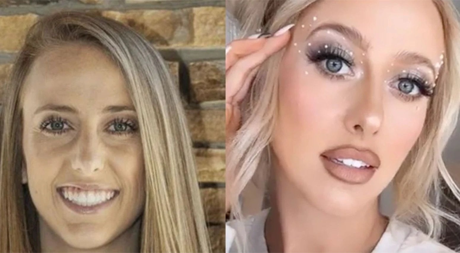 Brittany Mahomes plastic surgery,Brittany Mahomes lip fillers,cosmetic procedures,breast augmentation rumors,celebrity plastic surgery,Brittany Mahomes transformation,Patrick Mahomes wife surgery